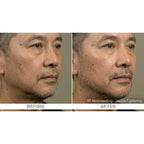 FirmX RF: RF Microneedling
