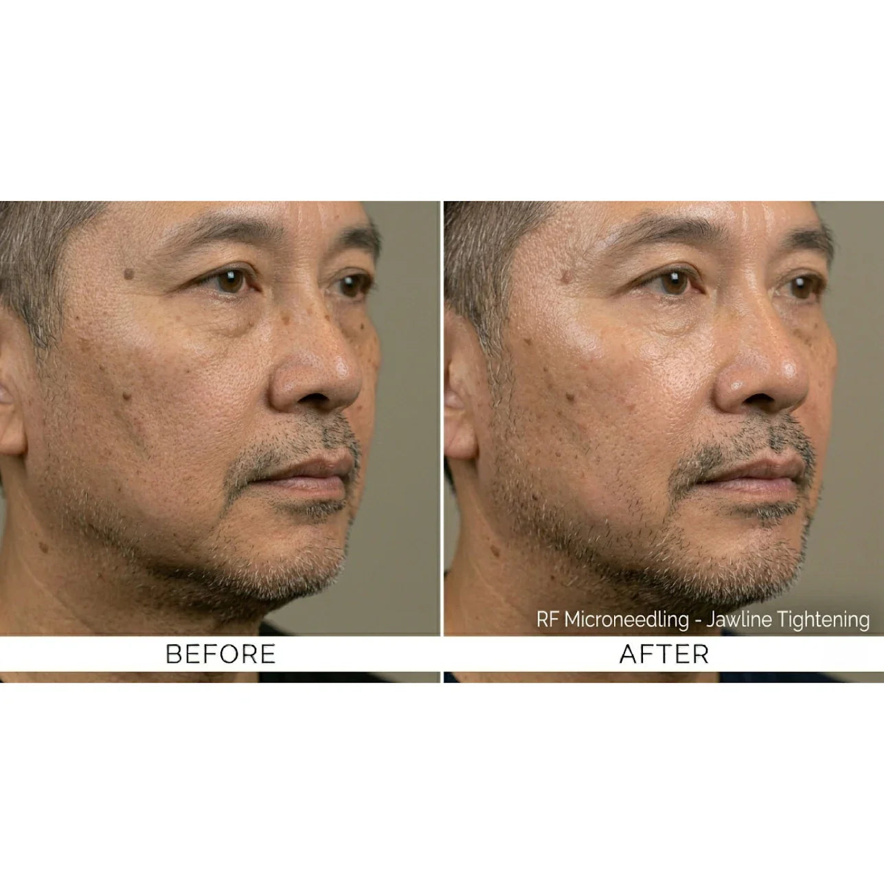 FirmX RF: RF Microneedling