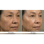 FirmX RF: RF Microneedling