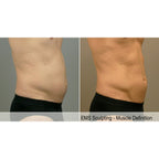 Tone Wave: EMS Body Sculpting