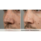 HydraGlow: Hydradermabrasion