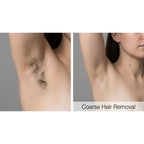 Dualis X: ND:YAG Laser