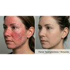 Dualis X: ND:YAG Laser