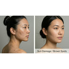 AuraLight: IPL Laser
