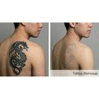 PicoPulse: Picosecond Laser