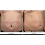 FirmX RF: RF Microneedling