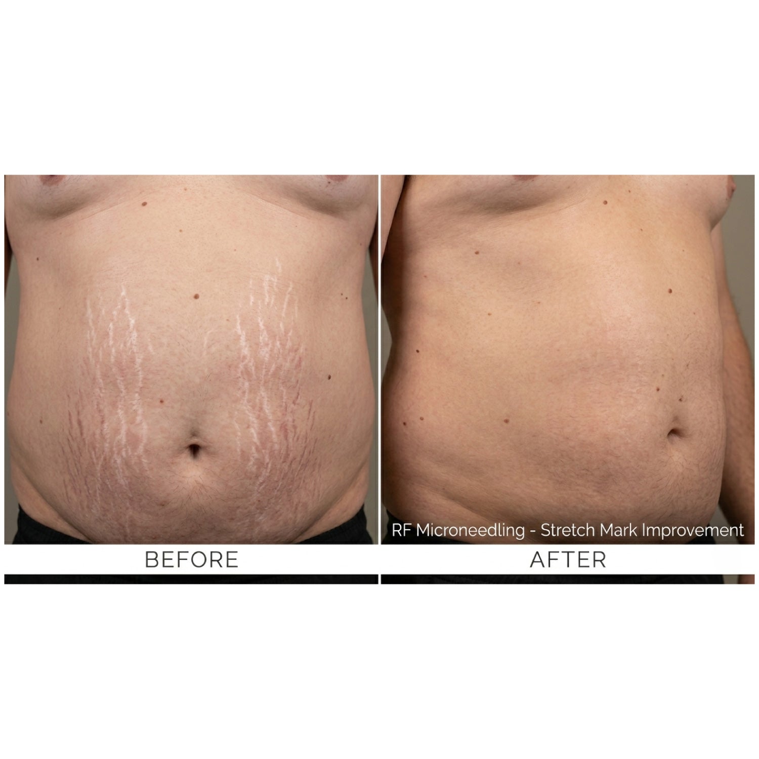 FirmX RF: RF Microneedling